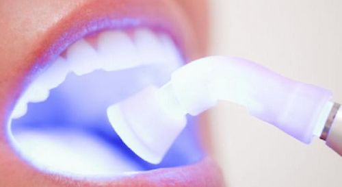 سفید کردن دندان چقدر طول می کشد؟