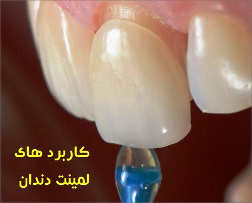 کاربرد های دیگر لمینت دندان