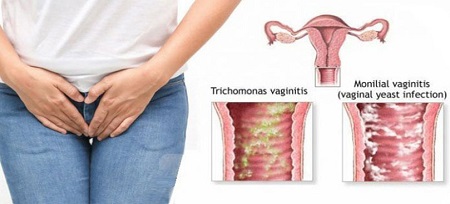 عکس مطلب عفونت قارچی واژن در بارداری و تاثیر عفونت قارچی واژن بر جنین